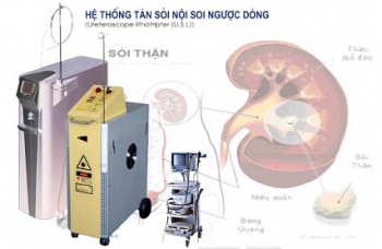 Máy tán sỏi nội soi ngược dòng bằng laser